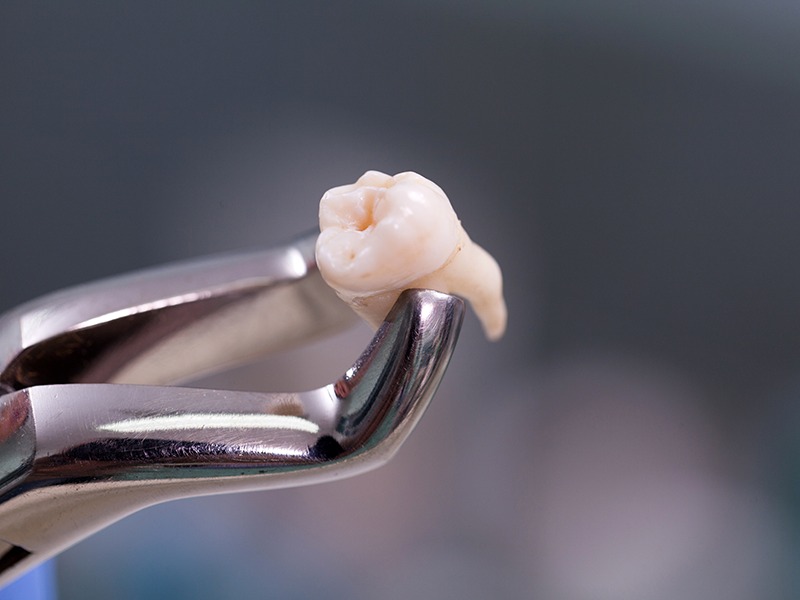 Пам'ятка пацієнтам після видалення зуба: чого чекати і що робити